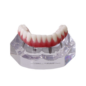 MANDÍBULA ACRÍLICA COM PROTOCOLO E 4 IMPLANTES - cód. 9568