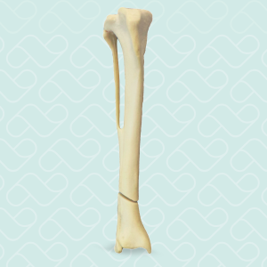 TIBIA ESPONJOSA COM FRATURA OBLIQUA DISTAL - DIREITA - CÃO GRANDE - cód. 10515