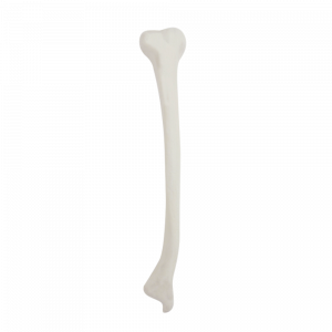 TÍBIA DIREITA COM DEFORMIDADE DISTAL VALGO - cód. 2031 DDVL