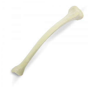 TIBIA ESQUERDA COM DEFORMIDADE 2 PLANOS MEDIAL POSTERIOR VALGO - cód. 2026 D2PMPVL