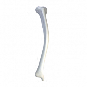TIBIA DIREITA COM DEFORMIDADE 2 PLANOS MEDIAL POSTERIOR VALGO - cód. 2031 D2PMPVL