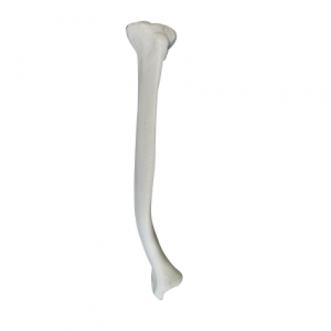 TÍBIA DIREITA COM DEFORMIDADE DISTAL SMA - cód. 2031 DD