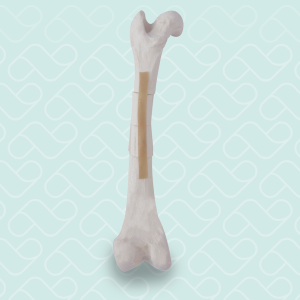 FEMUR ESPONJOSO COM FRATURAS MULTIPLAS 2 - ESQUERDO - CÃO GRANDE - cód. AV250ESPF3
